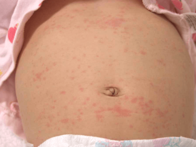子供 原因 蕁 麻疹