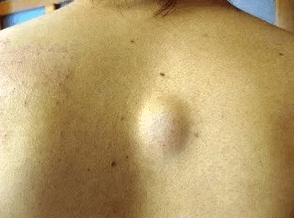 背中の脂肪腫の画像