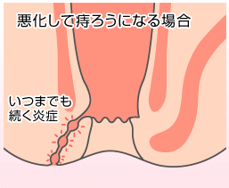 痔瘻の症状と治療方法