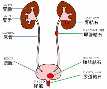 尿管結石の痛み止めに市販薬のロキソニンは効かない?座薬やボルタレンは? | 看護師ミカの健康ブログ