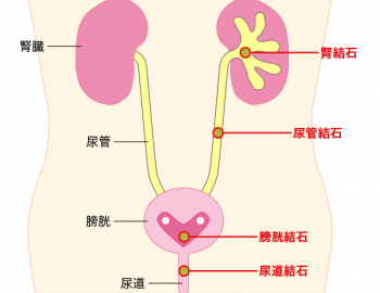 尿管結石は腎臓と膀胱の間の尿の通り道にできた結石