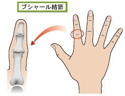 手指の関節の痛みの原因 ブシャール結節
