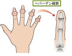 手指の関節の痛みの原因 ヘパーデン結節