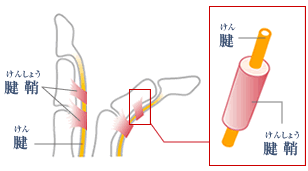 手指の関節の痛みの原因 腱鞘炎