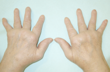 手指の関節の痛みの原因 関節リウマチ