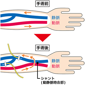 動脈と静脈の血管を皮下で繋いだシャント