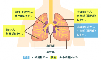 肺がんとは気管支や肺胞で発生する悪性腫瘍