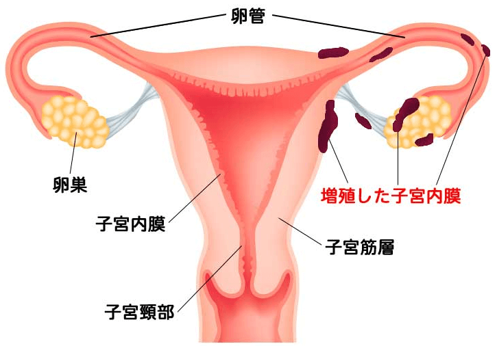 生理の血液が子宮の中を逆流して卵巣や直腸、膀胱などといった子宮以外の場所にくっついてしまう