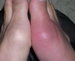 痛風発作が発生した足指の関節