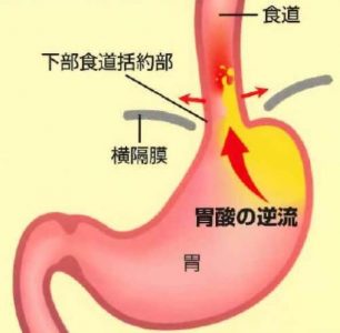 逆流性食道炎の胃の状態