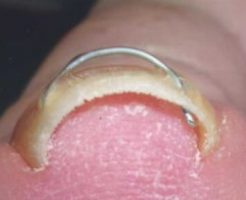 足の親指の巻き爪の治し方