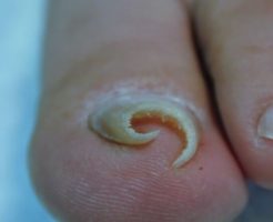 足の親指の巻き爪の原因