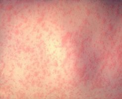 麻疹で起こる発疹の症状