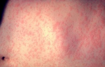 麻疹で起こる発疹の症状