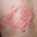 帯状疱疹の初期症状はヒリヒリチクチクした痛み？熱や頭痛などが出ることもある？
