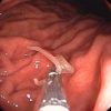 胃カメラでアニサキスを取り除く画像
