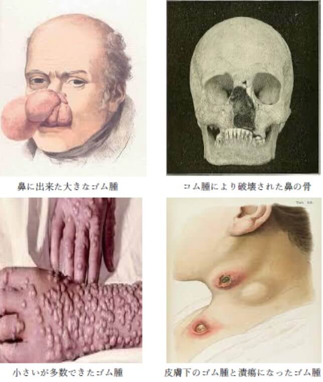 3期梅毒のゴム腫の症状の画像